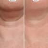 Boost Lab Edelweiss Neck Firming Serum – Before & After Close-Up Close-up before and after showing reduced neck fold and smoother skin texture with Boost Lab Neck Firming Serum