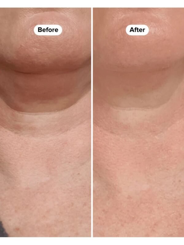 Boost Lab Edelweiss Neck Firming Serum – Before & After Close-Up Close-up before and after showing reduced neck fold and smoother skin texture with Boost Lab Neck Firming Serum