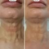 Boost Lab Edelweiss Neck Firming Serum – Before & After Neck Before and after comparison showing visibly reduced neck wrinkles and firmer skin after using Boost Lab Edelweiss Neck Firming Serum