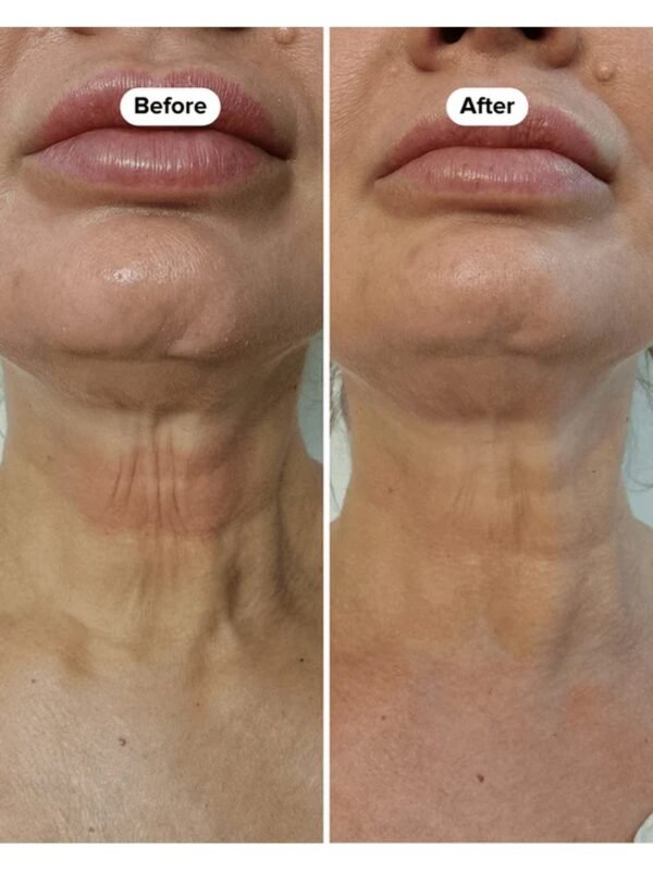 Boost Lab Edelweiss Neck Firming Serum – Before & After Neck Before and after comparison showing visibly reduced neck wrinkles and firmer skin after using Boost Lab Edelweiss Neck Firming Serum